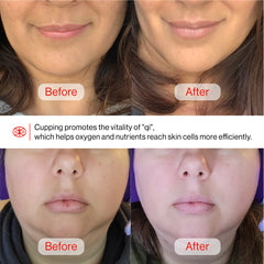 Facial Cupping & Rose Quartz Gua Sha Set Facial Cupping & Rose Quartz Gua Sha Set